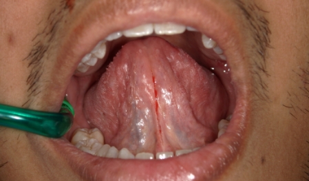 Close up of crowded teeth