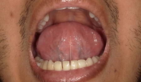 Close up of a smile with crowded teeth