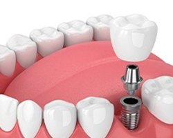 Diagram of single tooth dental implant in Alhambra 
