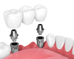 Diagram of dental implant for multiple missing teeth in Alhambra