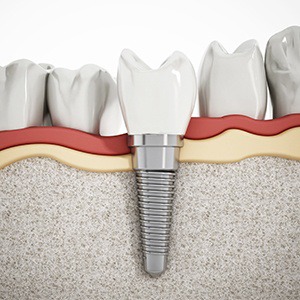 Parts of the cost of dental implants in Alhambra