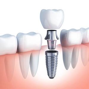 diagram of how dental implants work in Alhambra