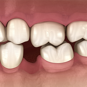 Animation of smile with missing tooth
