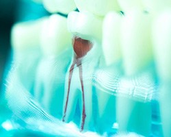 Closeup of a damaged tooth in a lower arch