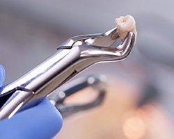 Tooth held by forceps