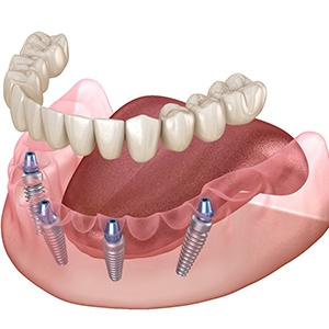 A digital image of a customized lower denture being secured over All-On-4 dental implants