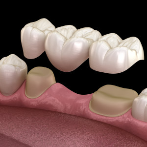 Illustration of a dental bridge being fitted over two teeth to fill the gap between them
