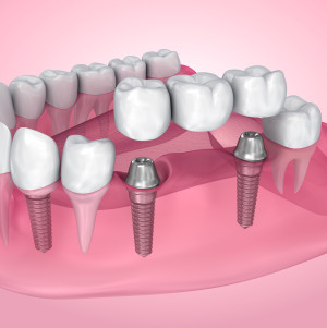 Illustration of a dental bridge being supported by two dental implants