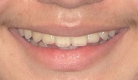 Close up of a smile with evenly spaced teeth
