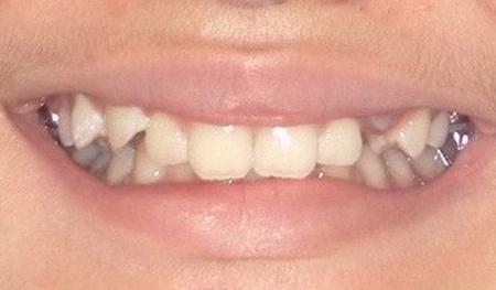 Close up of a smile with crowded teeth