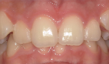 Close up of crowded teeth