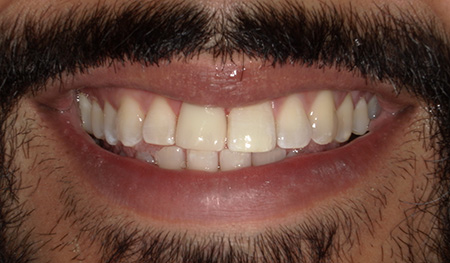 Close up of man smiling after getting a crown on his rotated front tooth