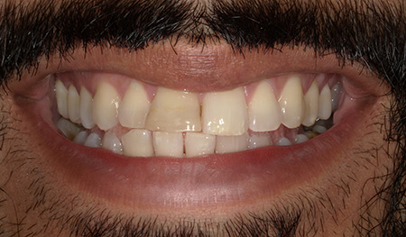 Close up of man smiling with a slightly rotated front tooth