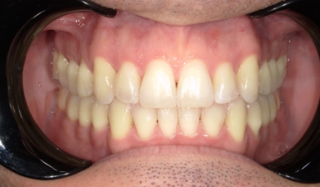 Close up of evenly spaced teeth