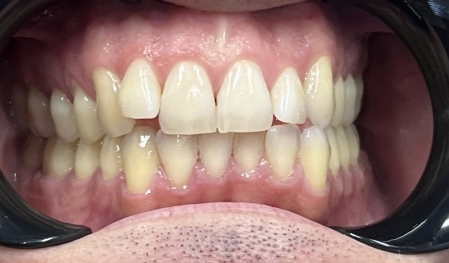 Close up of a smile with crowded teeth