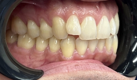 Close up of a smile with crowded teeth