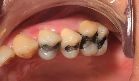 Row of teeth with dark metal fillings