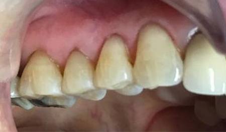 Row of teeth with natural looking tooth-colored fillings