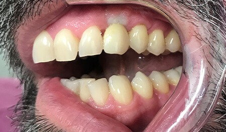 Row of teeth with missing tooth replaced