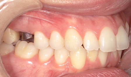 Row of teeth with one missing