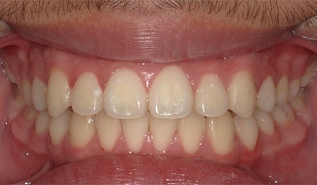 Row of teeth with missing tooth replaced