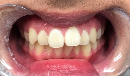 Row of teeth with one missing