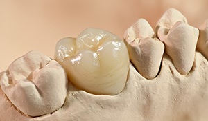 Model smile with dental crown in place