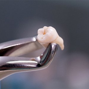 A tooth removed by a wisdom tooth extraction treatment
