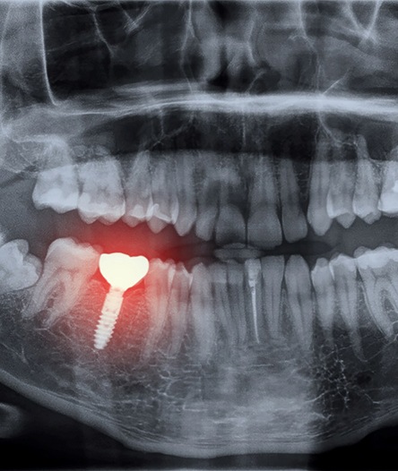 X-ray of a failing dental implant in Alhambra 