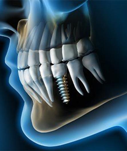 diagram of dental implants in Alhambra