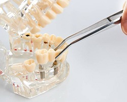 model of dental implant bridge in Alhambra