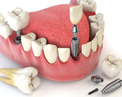 Diagram of dental implant surgery in Alhambra