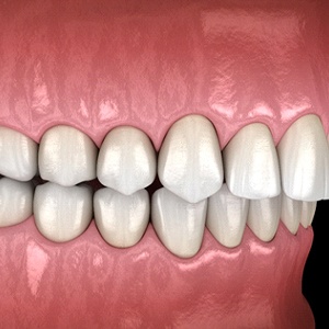 Overbite, example of a bite problem that Invisalign can fix