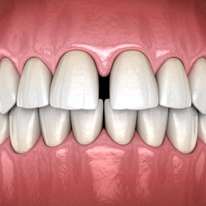 Gapped teeth, a spacing issue that Invisalign can correct