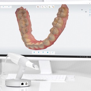 A digital impression system with a computer monitor showing a patient’s teeth as a 3D model