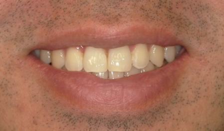 Close up of crowded teeth
