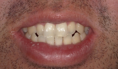 Close up of a smile with crowded teeth