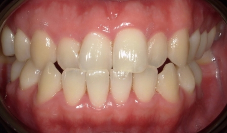 Close up of a smile with crowded teeth