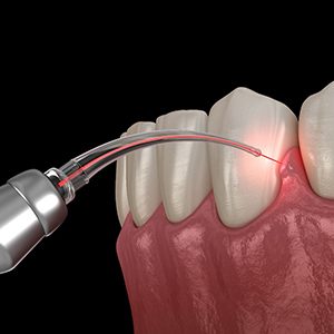 Realistic illustration of laser gum surgery 