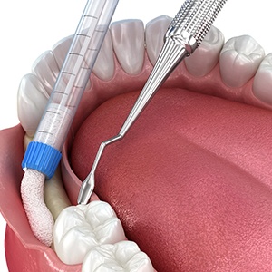 Realistic illustration of bone grafting