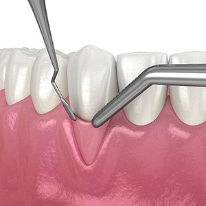 Realistic illustration of gum grafting 