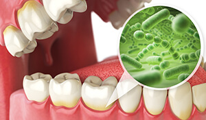 Animation of smile with green bacteria overlay