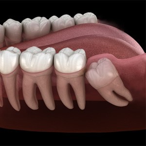 Digital illustration of impacted wisdom tooth
