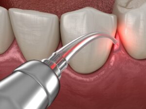 Close-up illustration of laser gum therapy in Alhambra