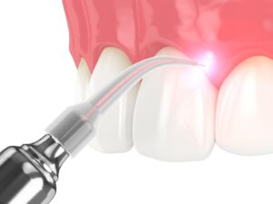 Illustration of laser periodontal therapy performed by Alhambra dentist