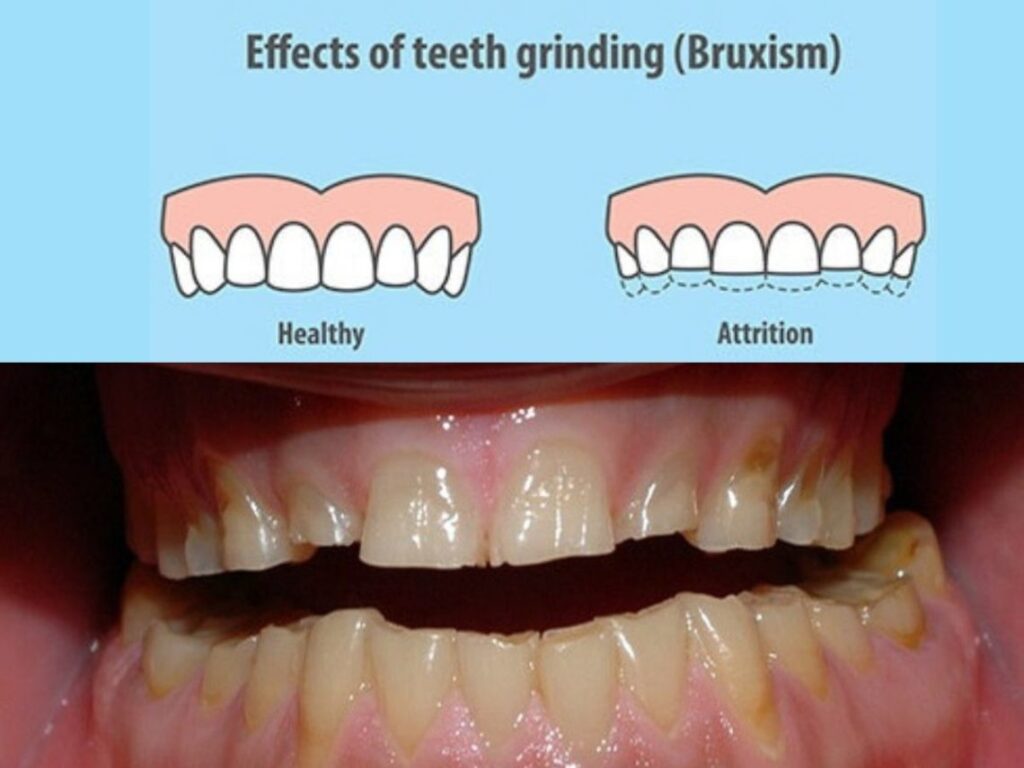 Comparison of a healthy bite and a bite after teeth grinding