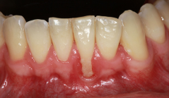 Gum recession caused by malocclusion